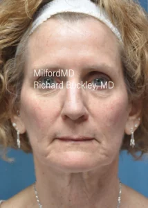 volume-loss-injectables-one-Front-Before-Milford-PA-MilfordMD.webp