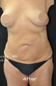 Breast-Aug-Tummy-Tuck-after-Milford-PA-MilfordMD