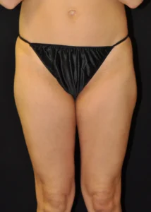 Laser-Lipo-Thigh-Procedures-Two-Front-After-Milford-PA-MilfordMD-1