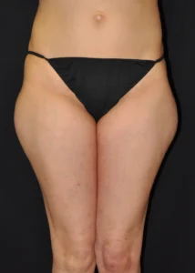 Laser-Lipo-Thigh-Procedures-Two-Front-Before-Milford-PA-MilfordMD-1