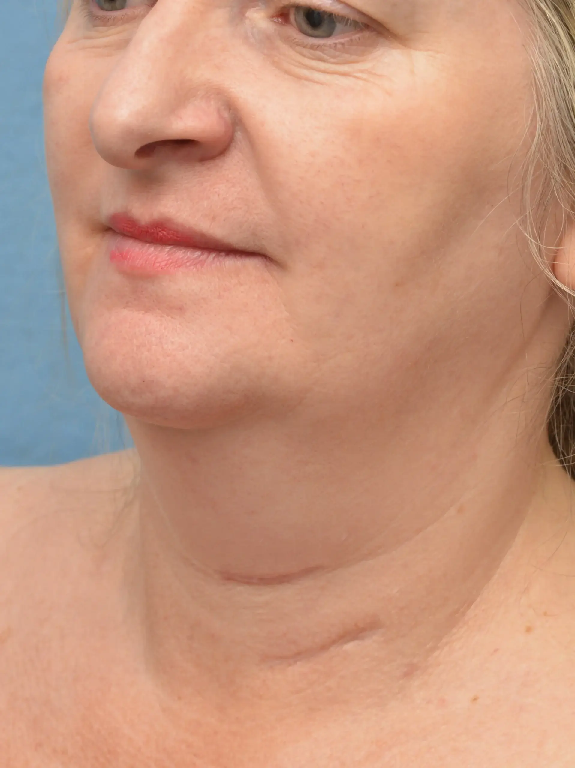 Before Neck rejuvenation results