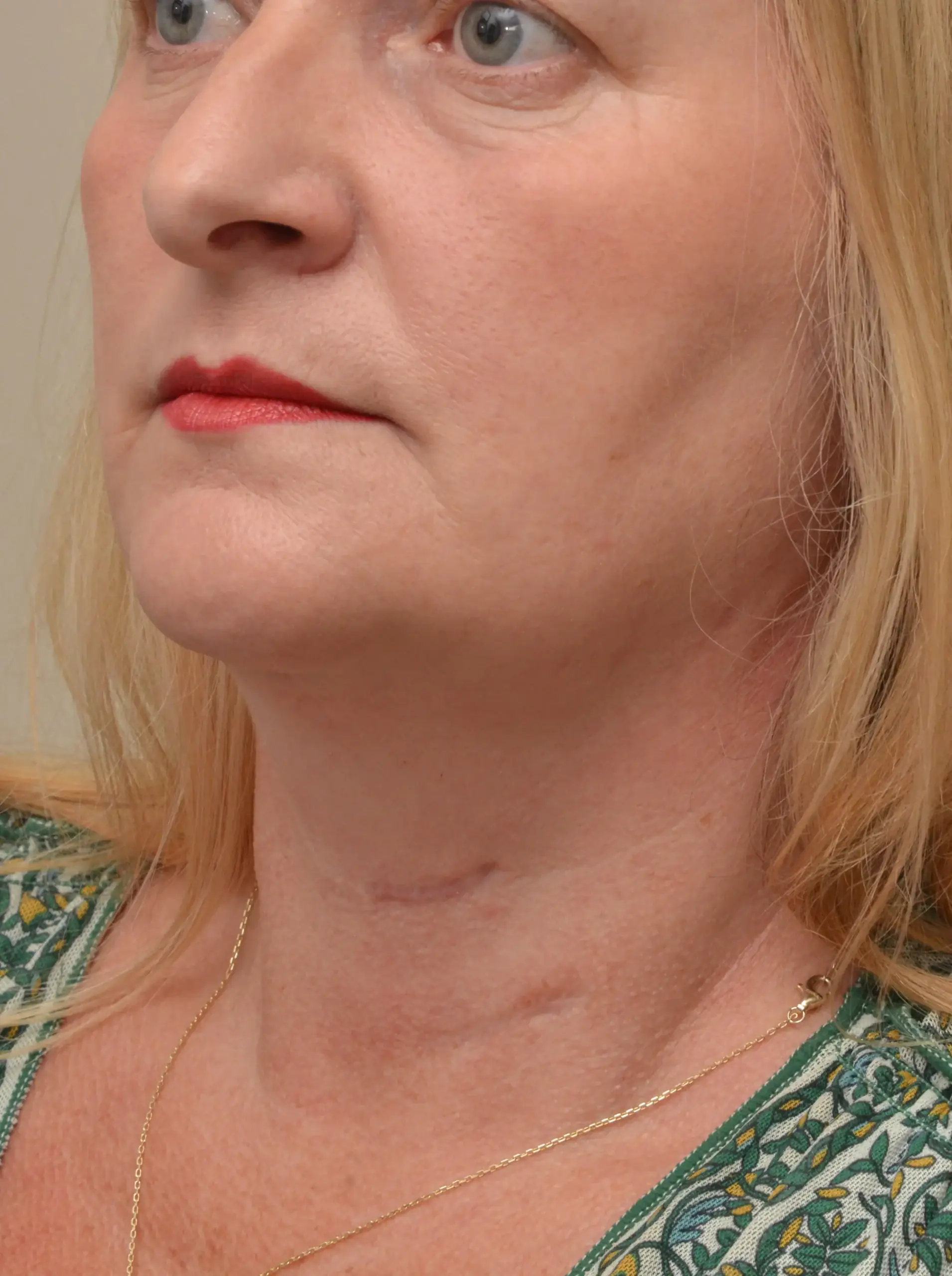 After neck rejuvenation results showing improved skin firmness