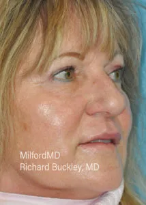 Blepharoplasty Lower Seven R Before and after