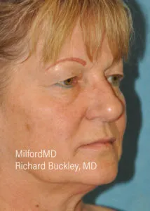Blepharoplasty Lower Seven R Before and after