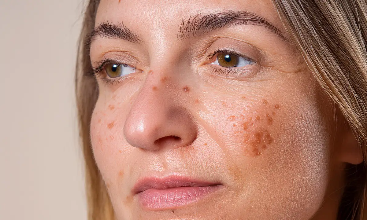 actinic keratosis treatment for-rough skin spots