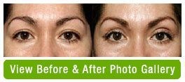 Before and after brow lift
