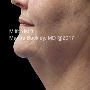 Before CoolSculpting® Neck
