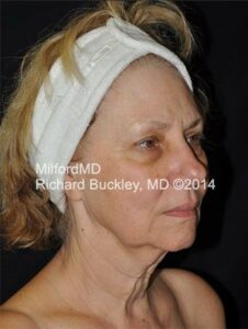 Before Liposuction Neck and Face Lift