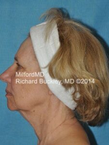 Before Liposuction Neck and Face Lift