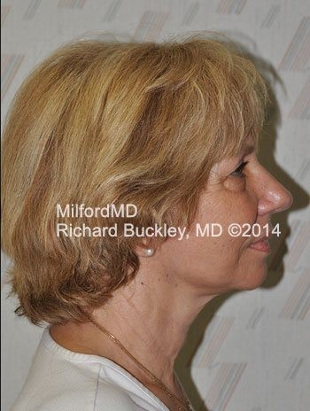 After Liposuction Neck and Face Lift