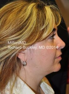 After Liposuction Neck and Jowl Lift