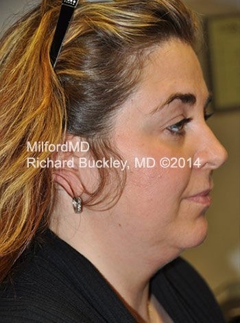 Before Liposuction Neck and Jowl Lift