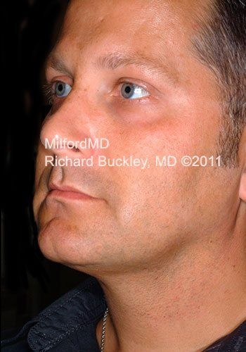 After Liposuction Male Neck and Face Lift