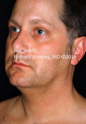 Before Liposuction Male Neck and Face Lift