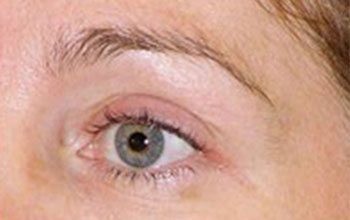 After Thermage® Brow Lift