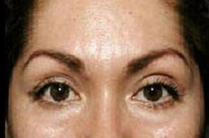 After Thermage® Brow Lift