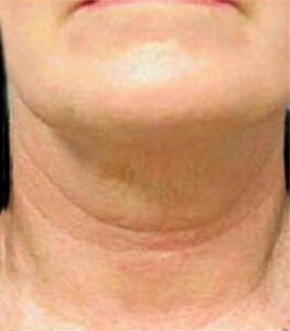 After Thermage® Jowls & Neck Lift