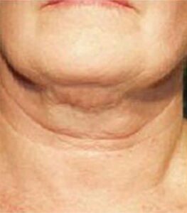 Before Thermage® Jowls & Neck Lift