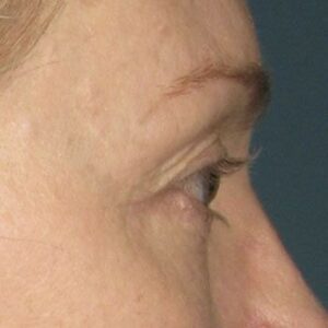 After Ultherapy® Brow Lift