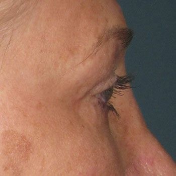 Before® Ultherapy Brow Lift