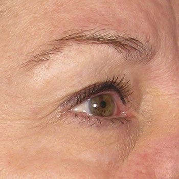 Before Ultherapy® Brow Lift