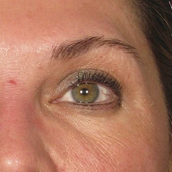 After Ultherapy® Brow Lift