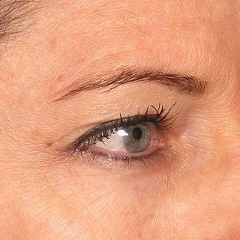 Before Ultherapy® Brow Lift