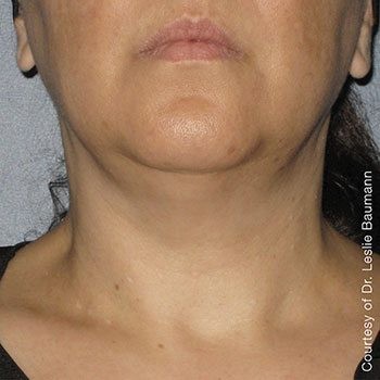 After Ultherapy® Neck Lift