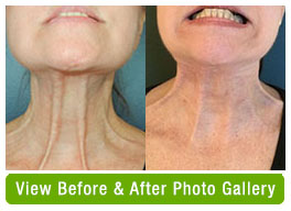 Before & After ThermiRase Neck Cord Relaxation Photos