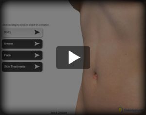 Watch Video Animations of Cosmetic Surgery Procedures