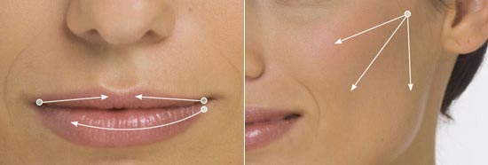 microcannula filler for lips and cheeks