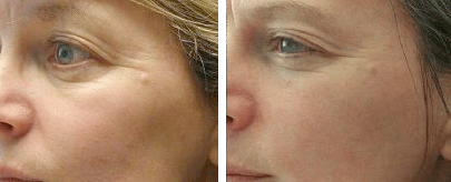 Light Therapy, Light Therapy for Wrinkles