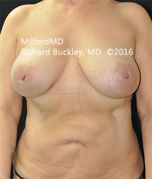 Breast Augmentation Silicone 372 After
