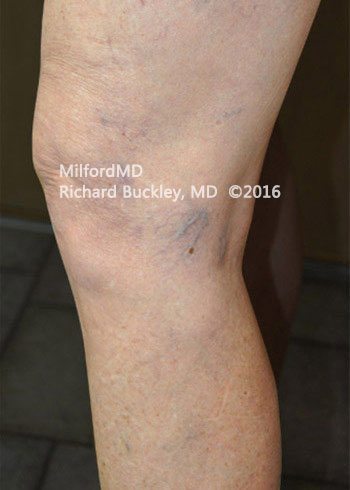Before Sclerotherapy Vein Treatment