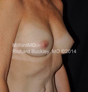 breast augmentation fat right 1a after