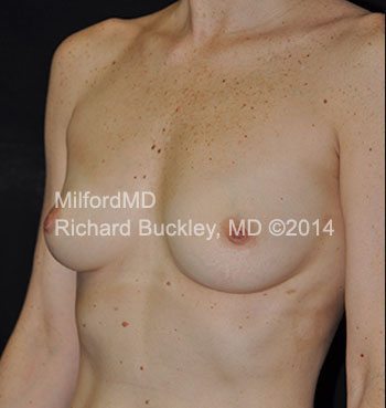 Before: BREAST AUGMENTATION AFT – Case #35877