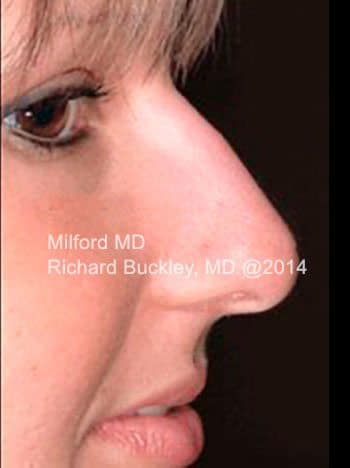 After Non-Surgical Rhinoplasty