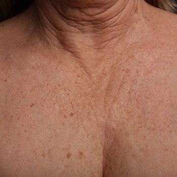 Before Ultherapy® Décolletage Rejuvenation