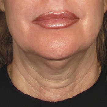 Before Ultherapy® for Lower Face