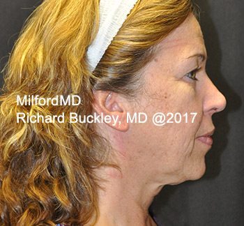 After Liposuction Neck Lift