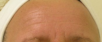 After HydraFacial MD® Treatment