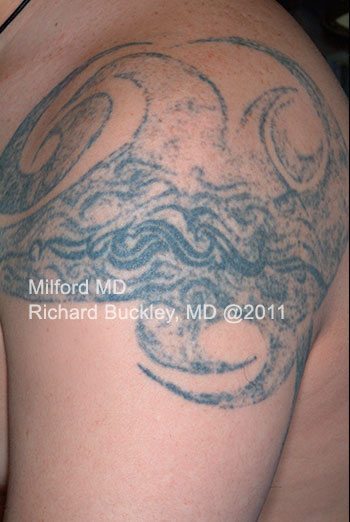 Before Laser Tattoo Removal