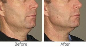 Ultherapy® for Lower Face