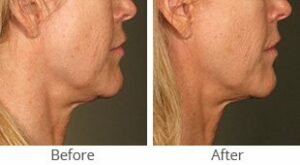 Ultherapy® for Lower Face