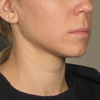 After Ultherapy® for Lower Face