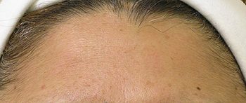 After HydraFacial MD® Forehead Wrinkles Treatment