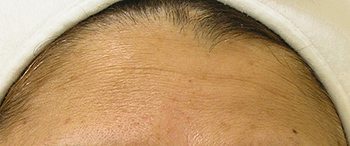Before HydraFacial MD® Forehead Wrinkles Treatment