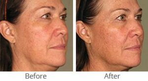Ultherapy® for Full Face