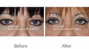 MilfordMD Skin Care Product Line | Blepharoplasty Upper Eyelid Tightening