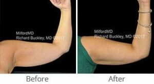 MilfordMD Skin Care Product Line | Laser Liposuction Arm Lf Before After